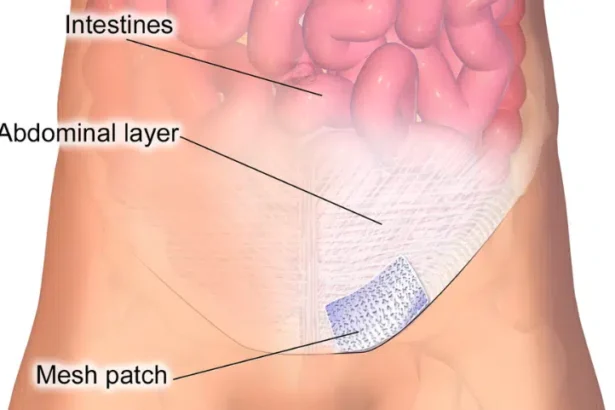 Hernia Mesh Lawsuit