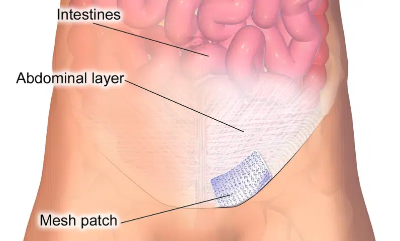 Hernia Mesh Lawsuit